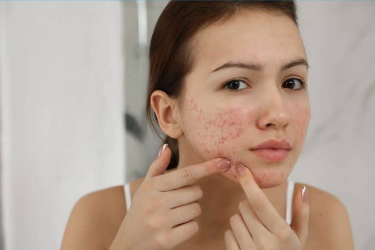 Does Sleeping Late Cause Acne (10 Thing You Can Do to Improve)